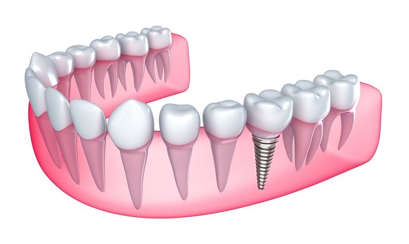 Đặt implant ngay sau khi nhổ răng sẽ giảm tình trạng tiêu xương hàm