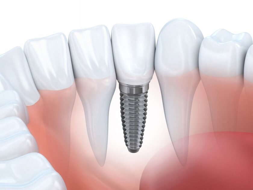 Trồng răng Implant tương đối an toàn