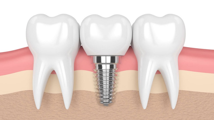 Răng implant độc lập, không tác động đến các răng xung quanh