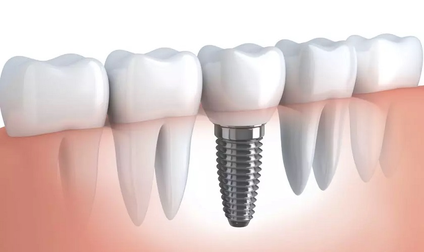 Trồng răng Implant đơn lẻ - Nha khoa Nhân Tâm