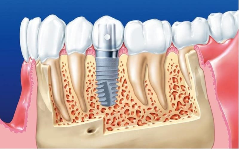 Trồng răng Implant giữ được bao lâu? Có bền không?