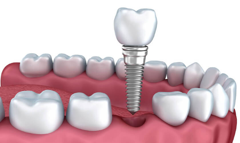 Trụ implant sẽ được cắm trực tiếp vào xương hàm