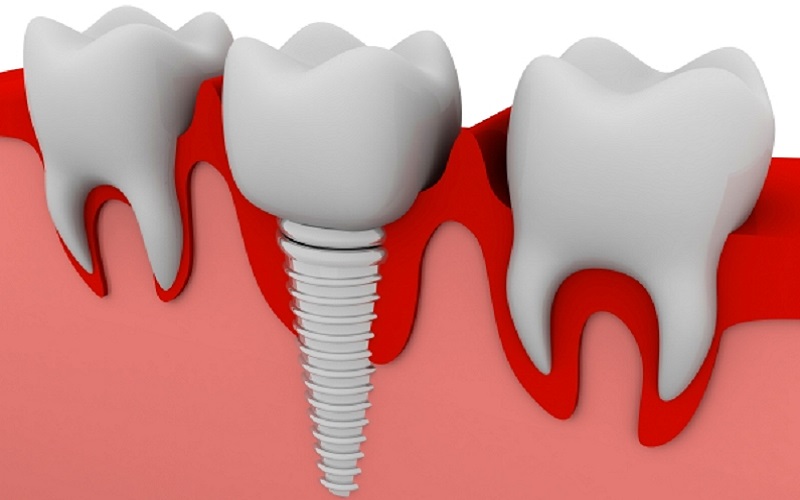 Trồng răng implant số 7 có tốt không?