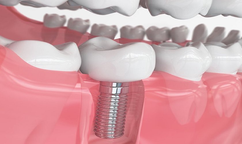 Trồng răng implant số 7 mất bao lâu tùy theo cơ địa của mỗi người