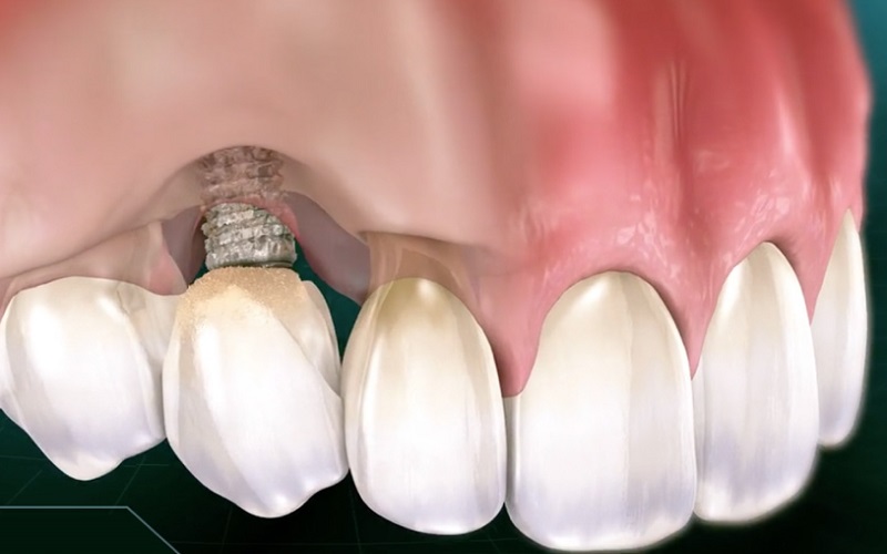 Trồng răng Implant bị thất bại nên xử lý thế nào?