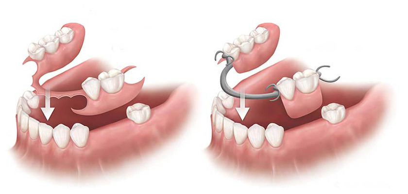 Làm cầu răng sứ hoặc hàm tháo lắp là phương pháp khắc phục cấy implant thất bại phổ biến