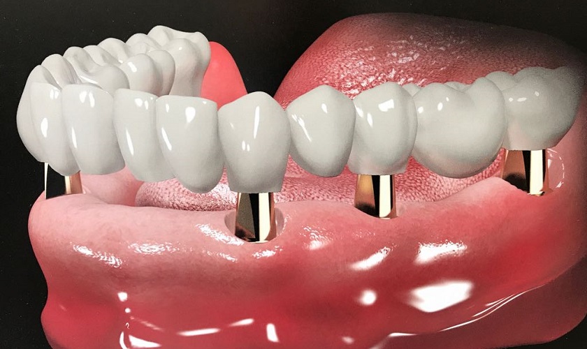 Trồng răng Implant toàn hàm có đau không?