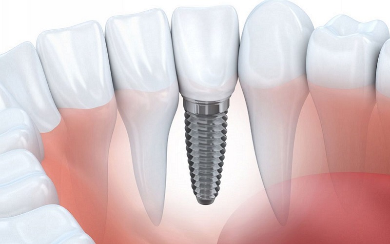 Trồng răng implant trả góp tại Nha Khoa Nhân Tâm