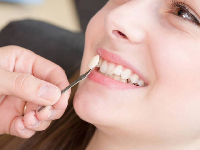 Trồng răng khểnh bằng cách đắp Composite có giá trị thẩm mỹ không cao