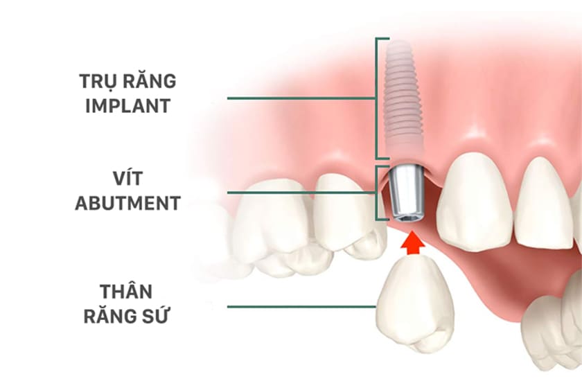 Trồng răng khểnh bằng phương pháp Implant là phương pháp hiện đại nhiều ưu điểm
