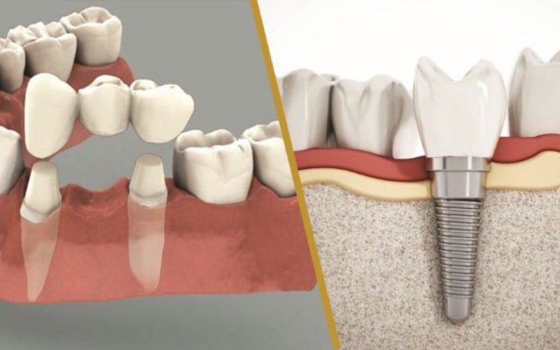Trồng răng vĩnh viễn là gì? phương pháp nào tốt?
