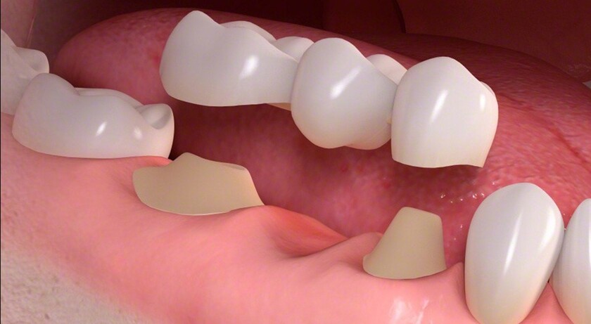 Trồng răng vĩnh viễn bằng cầu răng sứ khá phổ biến