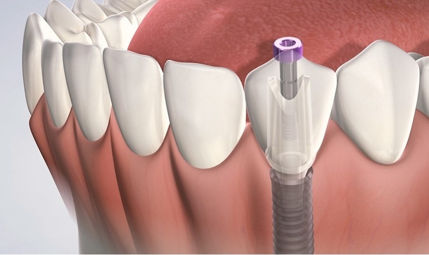 Cấy ghép răng implant hiện là giải pháp phục hình răng hoàn thiện và tốt nhất