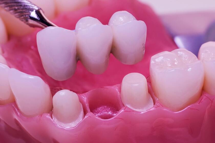 Làm cầu răng sứ dễ gây tác động xấu đến các răng kế cận