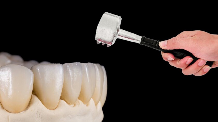 Độ bền của răng sứ có thể không kéo dài vĩnh viễn