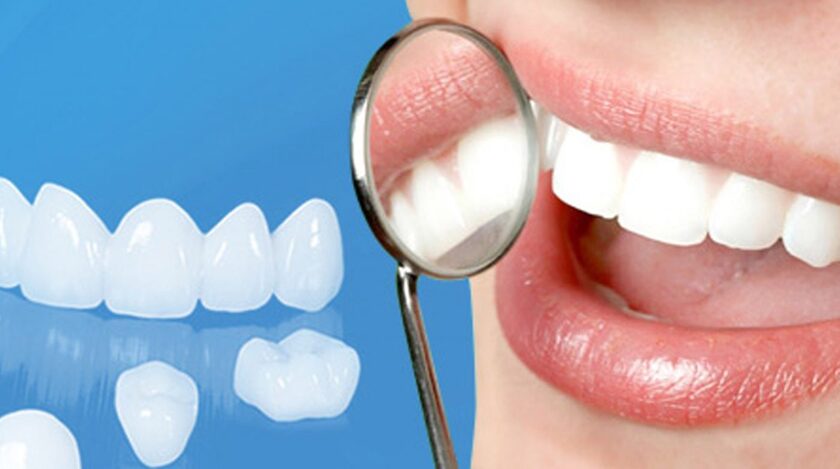 Tuổi thọ sử dụng của răng sứ cần phụ thuộc vào nhiều yếu tố