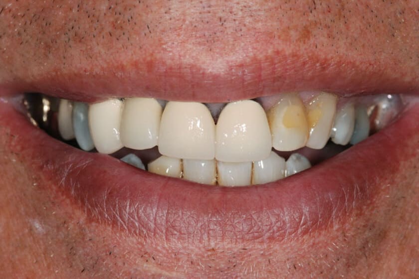 Tuổi thọ của loại răng sứ kim loại không cao chỉ khoảng 5-7 năm.