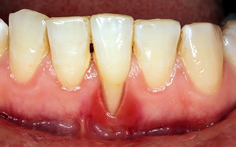Tụt nướu răng (tụt lợi) có chữa được không?