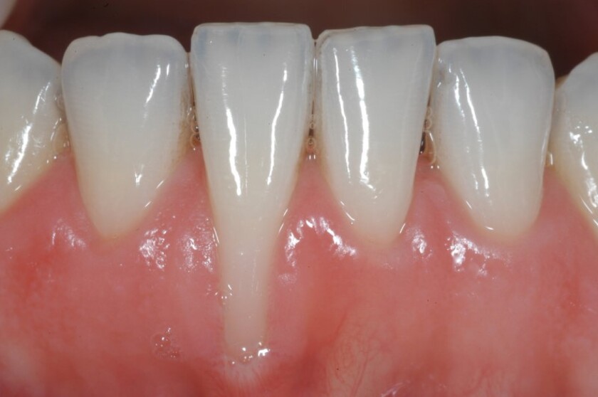 Tụt nướu có thể hậu quả của thói quen vệ sinh răng miệng kém