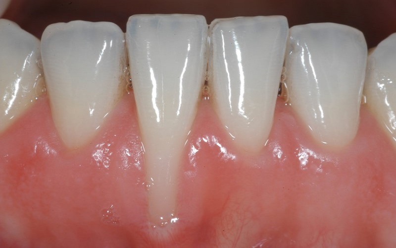 Tụt nướu răng là gì? Nguyên nhân và cách điều trị
