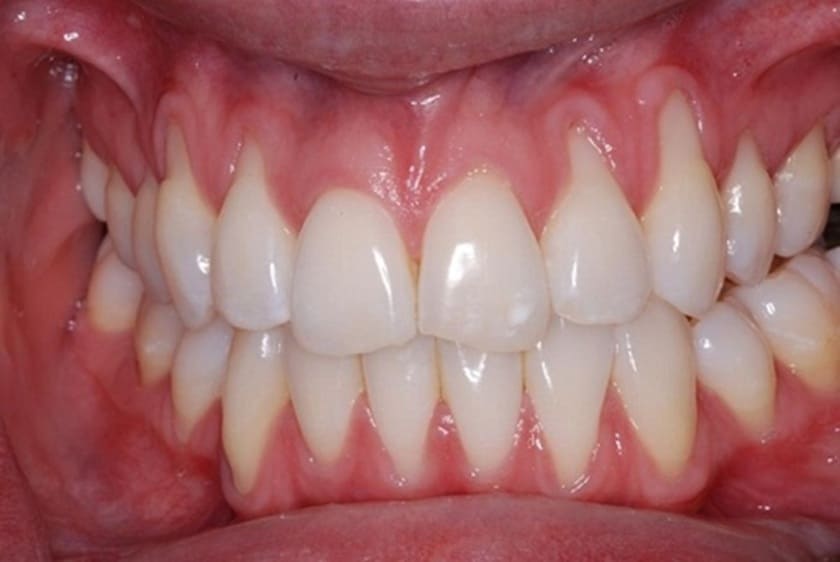 Tụt nướu là tình trạng nướu bị tụt về phía chân răng