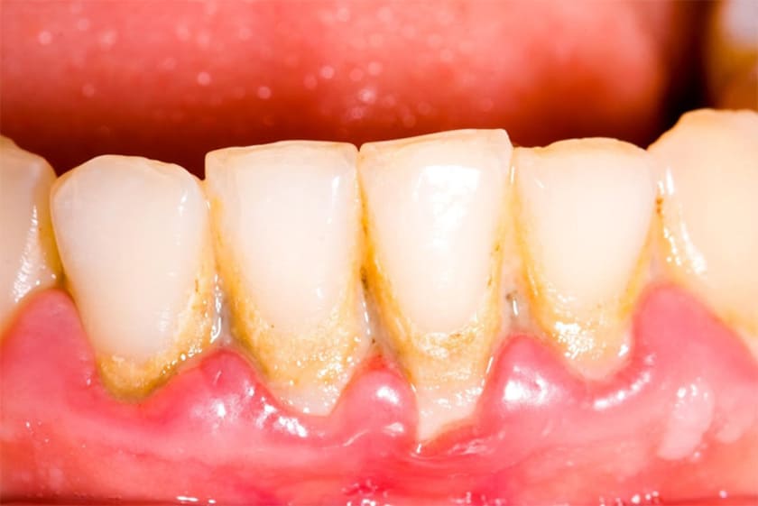 Vôi răng là nguyên nhân phổ biến gây bệnh nha chu