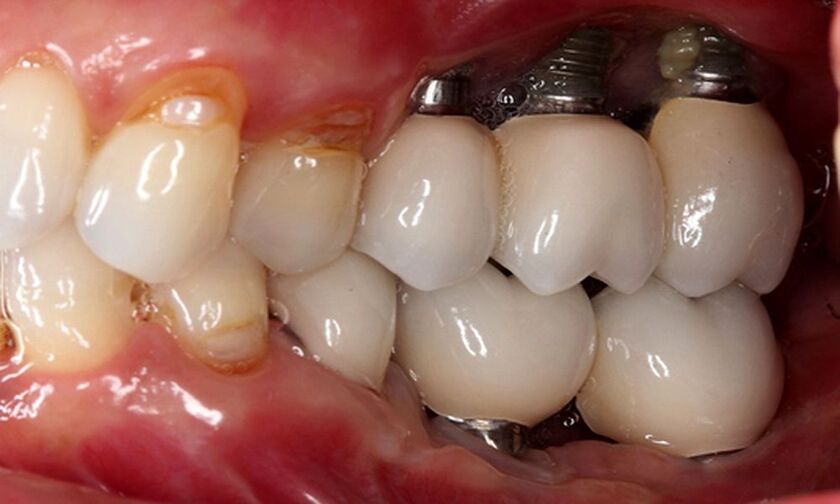 Nếu răng implant không được làm sạch đúng cách sẽ dễ bị viêm nhiễm