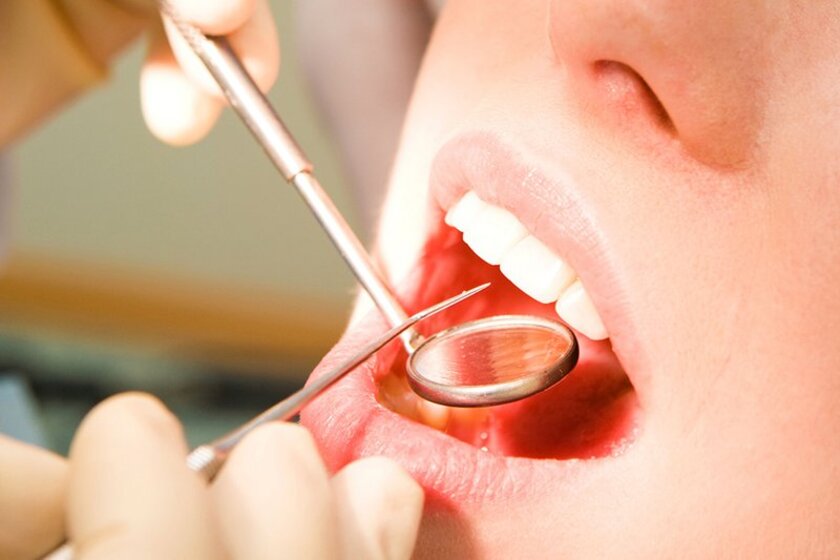 Loại bỏ vôi răng và làm sạch mảng bám là phương pháp điều trị cho tình trạng nhẹ