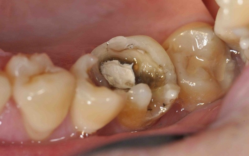 Viêm tủy răng có tự khỏi không? Nguy hiểm thế nào?