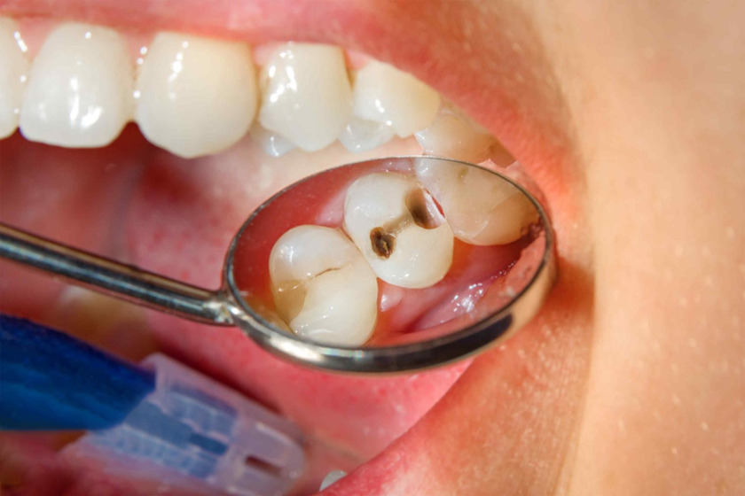 Vi khuẩn có hại sẽ dễ dàng xâm nhập và gây viêm tủy răng khi răng bị vỡ