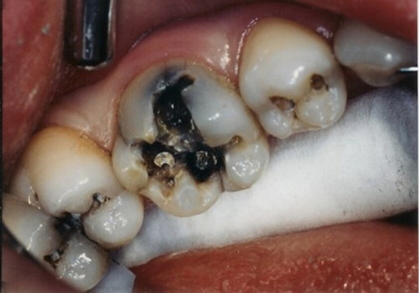 Viêm tủy răng nặng không thể tự khỏi