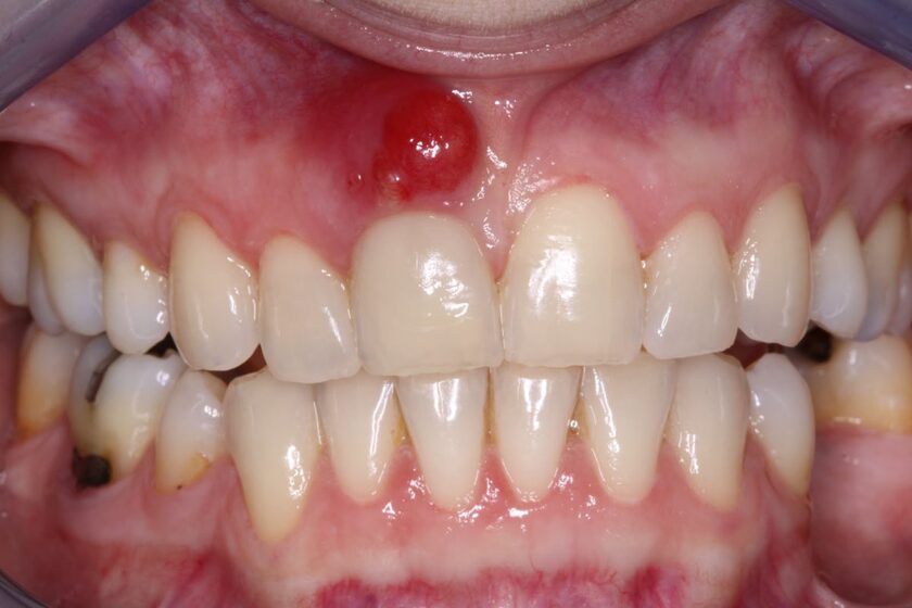 Nếu chữa tủy răng không đúng cách, ổ viêm sẽ lan rộng và gây viêm chân răng