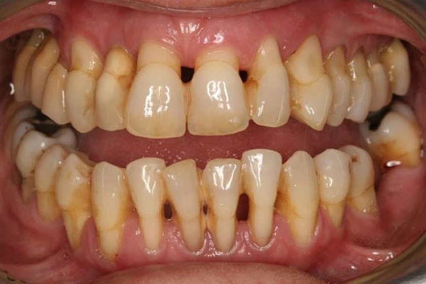 Các bệnh lý răng miệng cần được điều trị dứt điểm trước khi trồng răng implant
