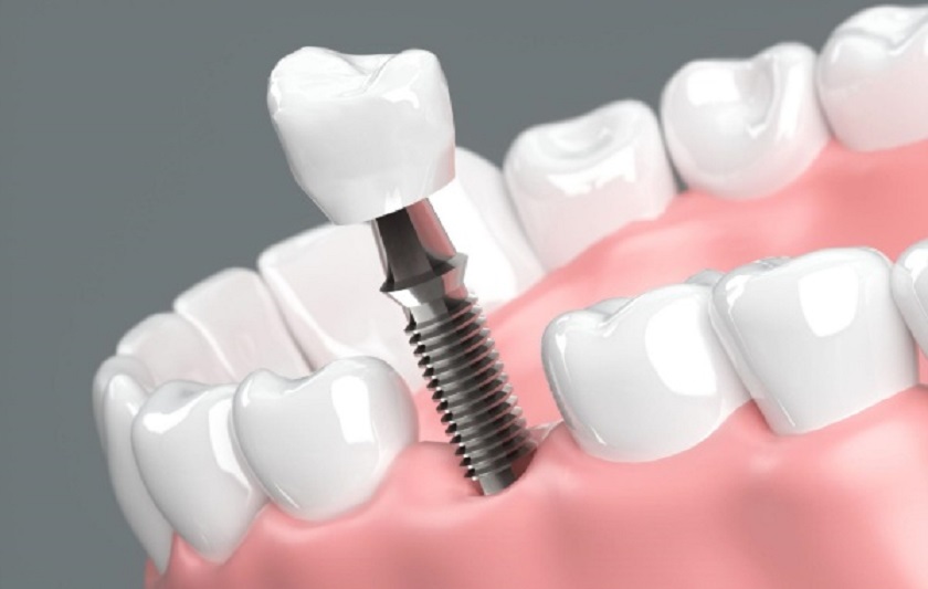 Phục hình răng bằng cấy ghép Implant