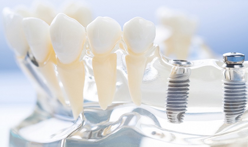 Kiến thức phổ cập trồng răng Implant mà bạn nên biết