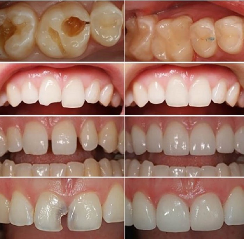 Các trường hợp có thể trám răng để tái tạo hình thể răng