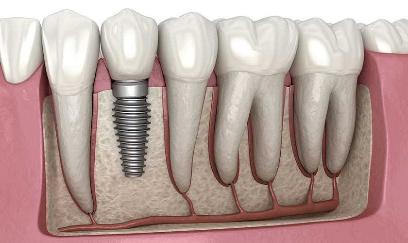 Phục hình răng bằng Implant nha khoa ngăn chặn tiêu xương