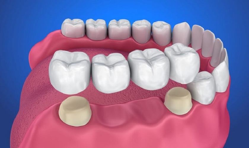Làm cầu răng sứ bị tiêu xương không? Giải pháp nào tốt hơn?