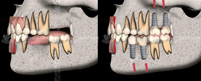 Trồng răng Implant ngăn ngừa tiêu xương hàm hiệu quả