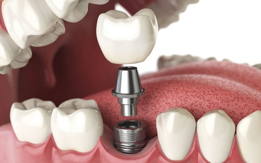 Sau khi cấy trụ Implant khách hàng cần đợi 3 – 6 tháng mới có thể gắn răng sứ