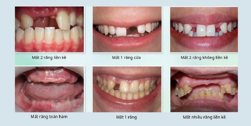Các tình trạng mất răng khác nhau sẽ có thời gian trồng răng Implant khác nhau