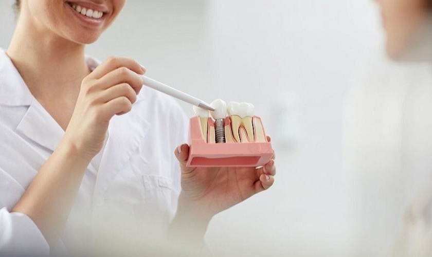 Làm răng Implant mất bao lâu? Implant Việt Nam