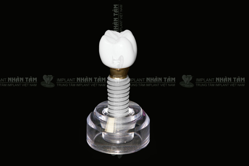 Trụ Implant được làm từ Titanium, một vật liệu quý hiếm và cao cấp