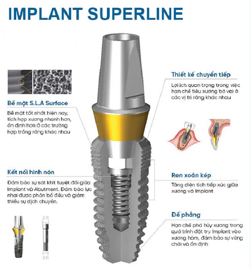 Trụ Implant Superline của Mỹ