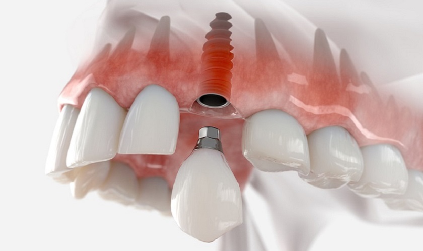 Trồng răng Implant – Kỹ thuật hồi sinh răng mất tân tiến và toàn diện nhất