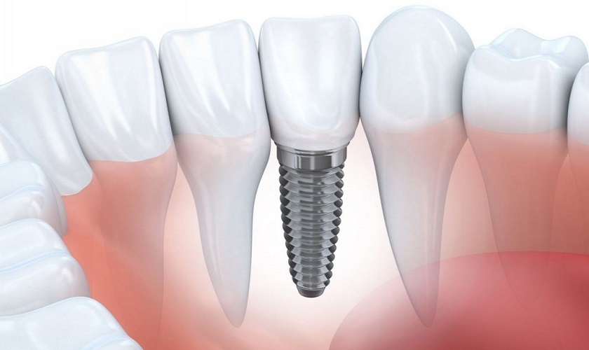 Răng Implant có thể tồn tại vĩnh viễn trên cung hàm nếu được chăm sóc, giữ gìn cẩn thận