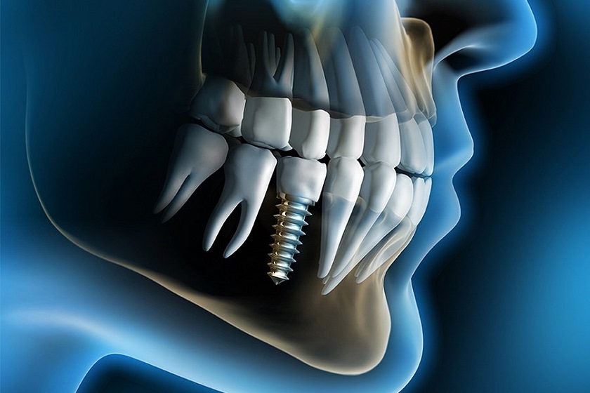 Răng Implant tồn tại độc lập với các răng khác, giúp bảo tồn tối đa răng thật cho khách hàng