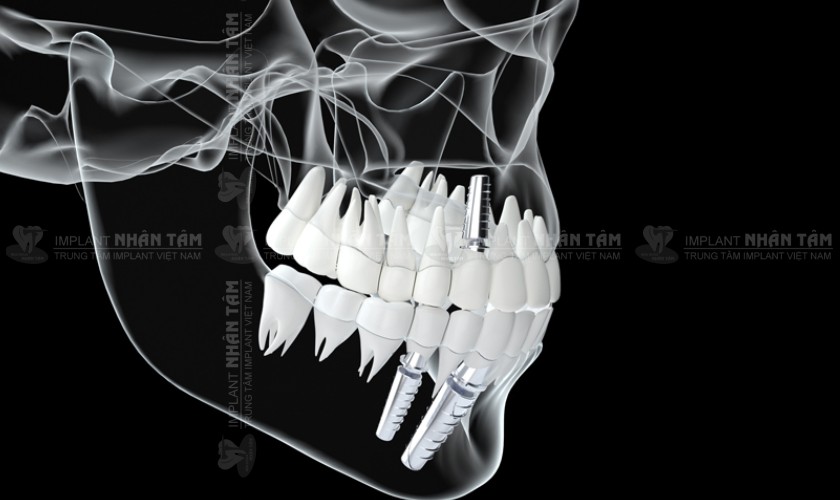 Cắm Implant tức thì sau nhổ răng trong trường hợp xương hàm khỏe mạnh