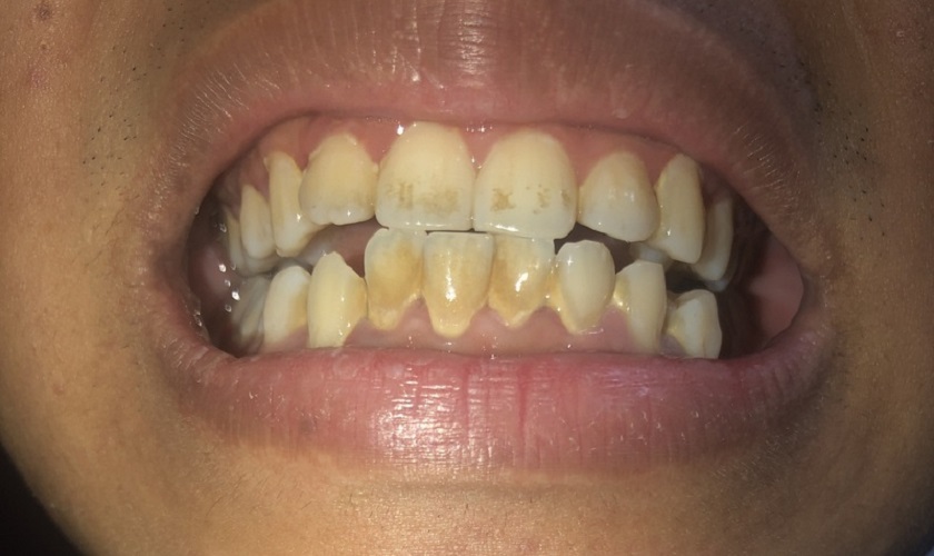 Mảng bám trên răng lâu ngày khiến răng bị ngả màu