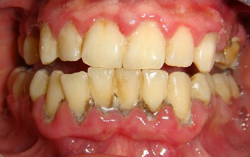 Tình trạng viêm nướu do mảng bám trên răng gây nên